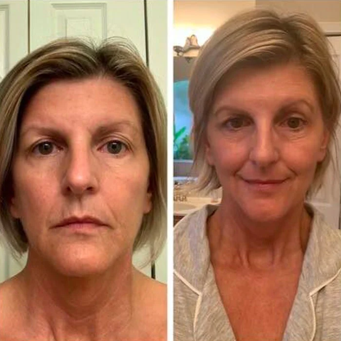 Before and after comparison of breast implant removal results